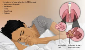 Infectious Diseases of the Respiratory System