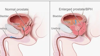 Prostate